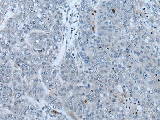 Immunohistochemistry of paraffin-embedded Human liver cancer tissue using NF1 Polyclonal Antibody at dilution of 1:65(×200)