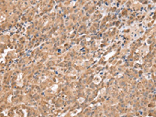 Immunohistochemistry of paraffin-embedded Human ovarian cancer tissue using DDX58 Polyclonal Antibody at dilution of 1:40(×200)