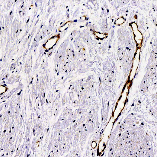 Immunohistochemistry analysis of paraffin-embedded Human hysteromyoma using VWF Polyclonal Antibody at dilution of 1:300.