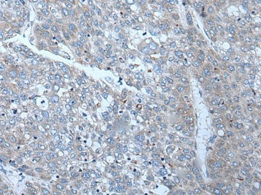 Immunohistochemistry of paraffin-embedded Human liver cancer tissue using SLC24A5 Polyclonal Antibody at dilution of 1:50(×200)