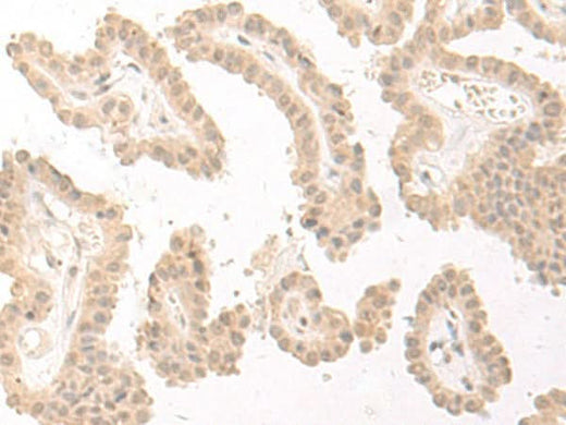 Immunohistochemistry of paraffin-embedded Human thyroid cancer tissue using PBXIP1 Polyclonal Antibody at dilution of 1:40(×200)