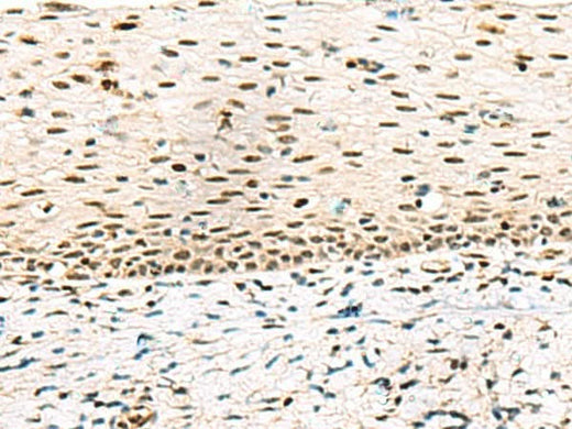 Immunohistochemistry of paraffin-embedded Human cervical cancer tissue using ABI2 Polyclonal Antibody at dilution of 1:45(×200)