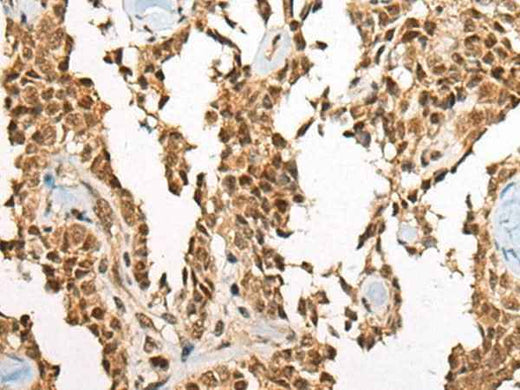 Immunohistochemistry of paraffin-embedded Human ovarian cancer tissue using ATE1 Polyclonal Antibody at dilution of 1:60(×200)