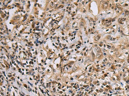 Immunohistochemistry of paraffin-embedded Human esophagus cancer tissue using DNA2 Polyclonal Antibody at dilution of 1:60(×200)