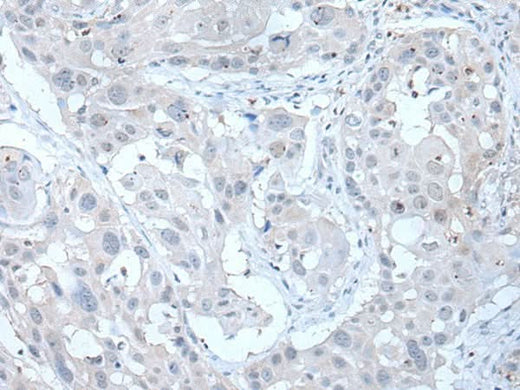 Immunohistochemistry of paraffin-embedded Human esophagus cancer tissue using ANGPTL6 Polyclonal Antibody at dilution of 1:55(×200)