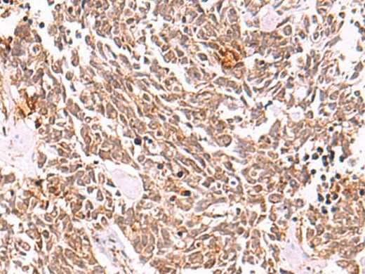 Immunohistochemistry of paraffin-embedded Human lung cancer tissue using COPS3 Polyclonal Antibody at dilution of 1:50(×200)