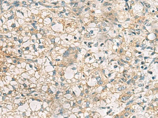 Immunohistochemistry of paraffin-embedded Human liver cancer tissue using RTP4 Polyclonal Antibody at dilution of 1:50(×200)