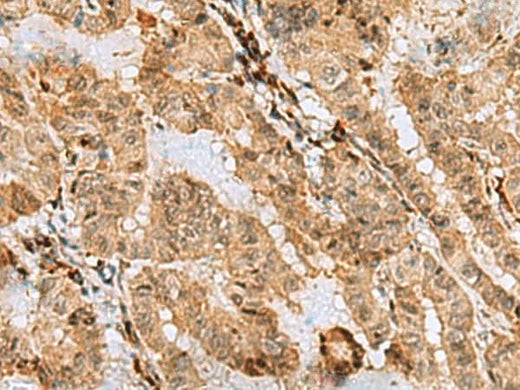 Immunohistochemistry of paraffin-embedded Human thyroid cancer tissue using ASNA1 Polyclonal Antibody at dilution of 1:70(×200)