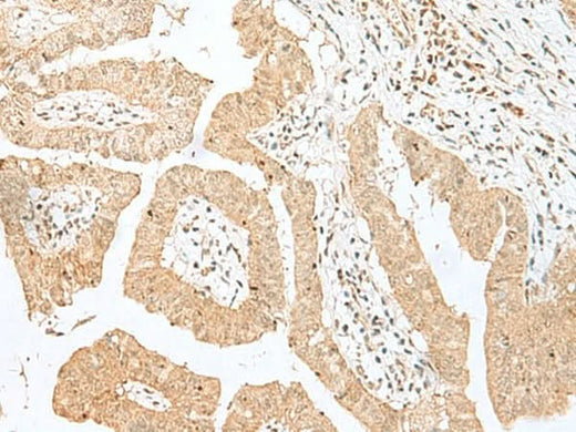 Immunohistochemistry of paraffin-embedded Human liver cancer tissue using BEX2 Polyclonal Antibody at dilution of 1:50(×200)