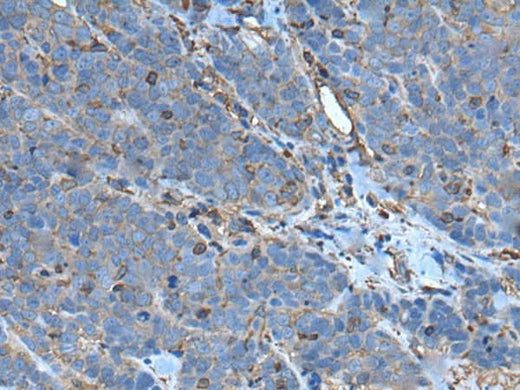 Immunohistochemistry of paraffin-embedded Human thyroid cancer tissue using SLC24A5 Polyclonal Antibody at dilution of 1:50(×200)