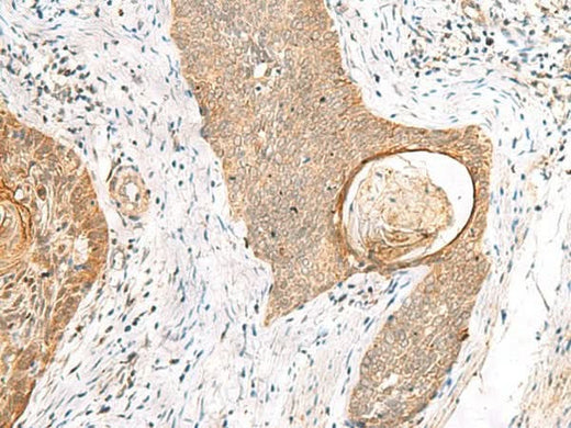 Immunohistochemistry of paraffin-embedded Human esophagus cancer tissue using TOR1A Polyclonal Antibody at dilution of 1:35(×200)