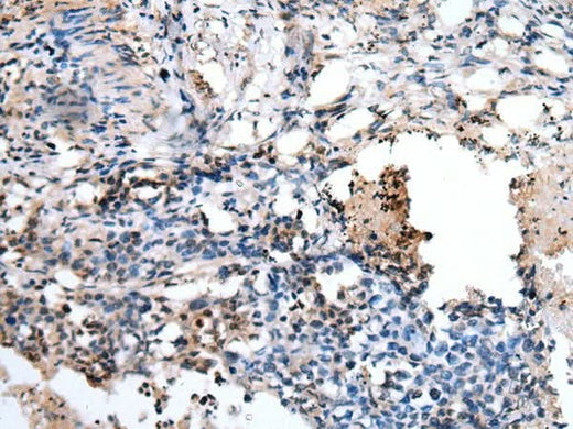 Immunohistochemistry of paraffin-embedded Human lung cancer tissue using PPP1R15A Polyclonal Antibody at dilution of 1:45(×200)