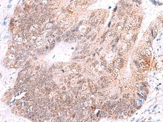 Immunohistochemistry of paraffin-embedded Human colorectal cancer tissue using ASTN2 Polyclonal Antibody at dilution of 1:55(×200)