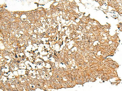 Immunohistochemistry of paraffin-embedded Human lung cancer tissue using PRLHR Polyclonal Antibody at dilution of 1:70(×200)