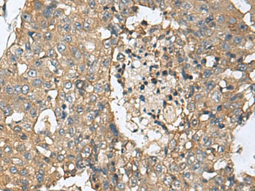 Immunohistochemistry of paraffin-embedded Human liver cancer tissue using CD59 Polyclonal Antibody at dilution of 1:160(×200)