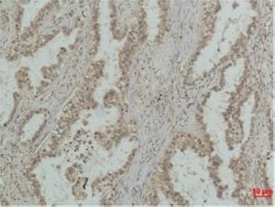 IHC staining of human lung carcinoma with P53 mono-methyl Lys370 antibody clone 4A1 at 1:500 dilution