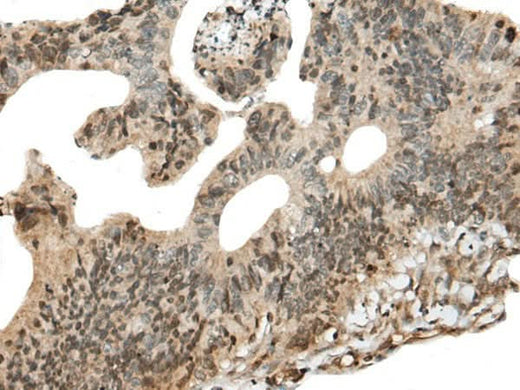 Immunohistochemistry of paraffin-embedded Human colorectal cancer tissue using CALML5 Polyclonal Antibody at dilution of 1:90(×200)