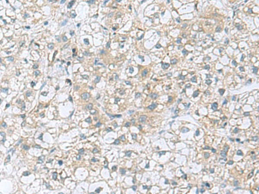 Immunohistochemistry of paraffin-embedded Human liver cancer tissue using TRO Polyclonal Antibody at dilution of 1:80(×200)