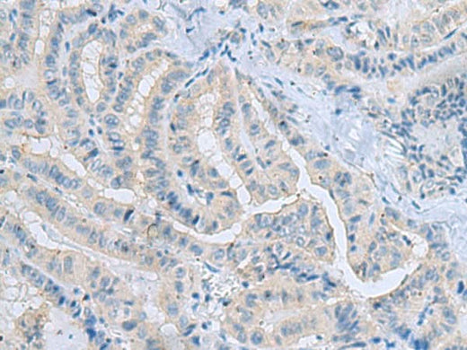 Immunohistochemistry of paraffin-embedded Human thyroid cancer tissue using MSI2 Polyclonal Antibody at dilution of 1:70(×200)