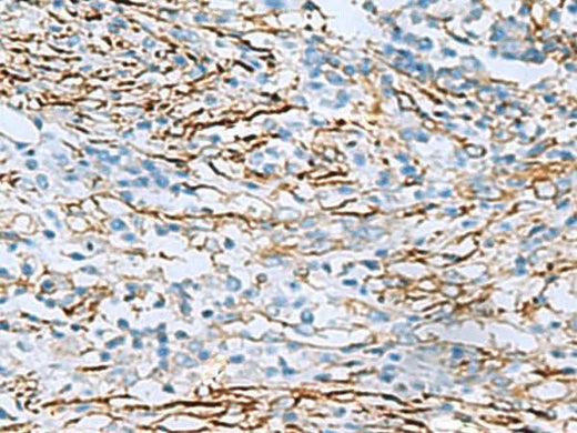 Immunohistochemistry of paraffin-embedded Human breast cancer tissue using DPYSL3 Polyclonal Antibody at dilution of 1:55(×200)