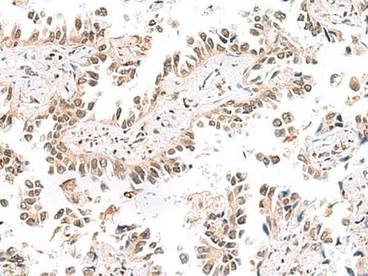 Immunohistochemistry of paraffin-embedded Human lung cancer tissue using KCTD13 Polyclonal Antibody at dilution of 1:50(×200)