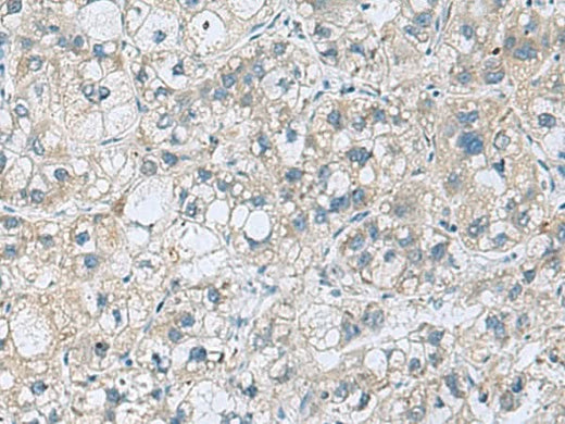Immunohistochemistry of paraffin-embedded Human liver cancer tissue using KCNJ2 Polyclonal Antibody at dilution of 1:35(×200)
