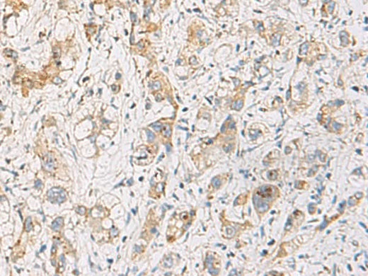 Immunohistochemistry of paraffin-embedded Human liver cancer tissue using FYCO1 Polyclonal Antibody at dilution of 1:110(×200)