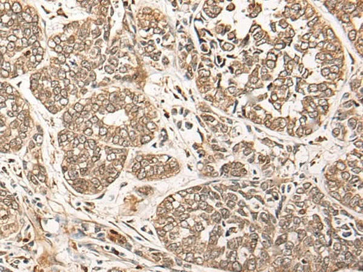 Immunohistochemistry of paraffin-embedded Human esophagus cancer tissue using CA5B Polyclonal Antibody at dilution of 1:85(×200)