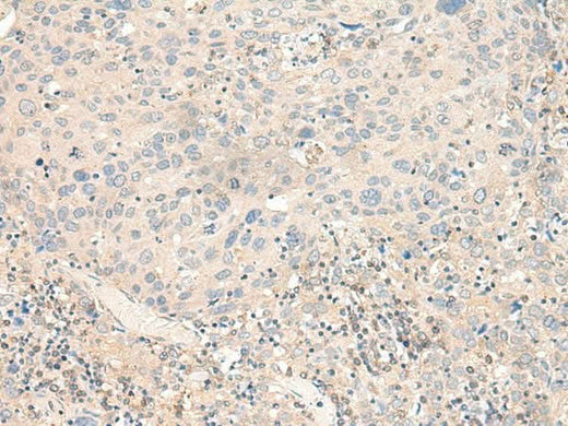 Immunohistochemistry of paraffin-embedded Human cervical cancer tissue using KCNA10 Polyclonal Antibody at dilution of 1:40(×200)