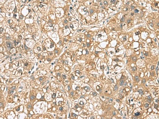 Immunohistochemistry of paraffin-embedded Human liver cancer tissue using PTPRS Polyclonal Antibody at dilution of 1:110(×200)