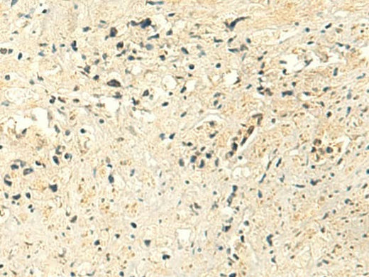 Immunohistochemistry of paraffin-embedded Human prost at e cancer tissue using MTHFS Polyclonal Antibody at dilution of 1:50(×200)