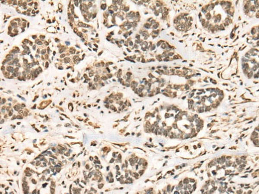 Immunohistochemistry of paraffin-embedded Human esophagus cancer tissue using BRD7 Polyclonal Antibody at dilution of 1:50(×200)