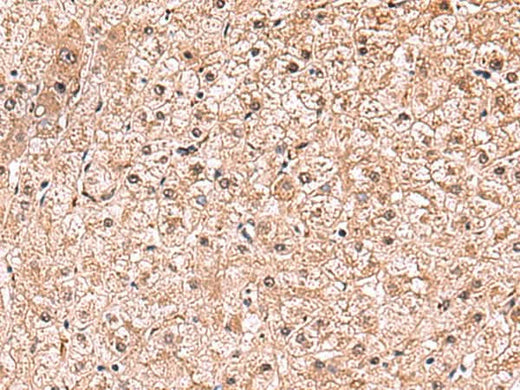 Immunohistochemistry of paraffin-embedded Human liver cancer tissue using RUSC1 Polyclonal Antibody at dilution of 1:90(×200)