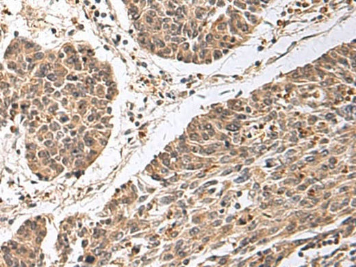 Immunohistochemistry of paraffin-embedded Human colorectal cancer tissue using CD24 Polyclonal Antibody at dilution of 1:25(×200)
