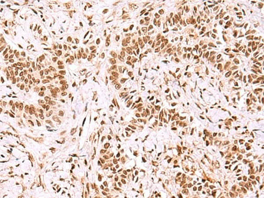 Immunohistochemistry of paraffin-embedded Human ovarian cancer tissue using GPKOW Polyclonal Antibody at dilution of 1:100(×200)