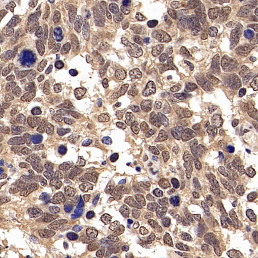 Immunohistochemistry analysis of paraffin-embedded human lung cancer using JUN Polyclonal Antibody at dilution of 1:500.