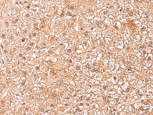 Immunohistochemistry of paraffin-embedded Human liver cancer tissue using ASTN2 Polyclonal Antibody at dilution of 1:80(×200)