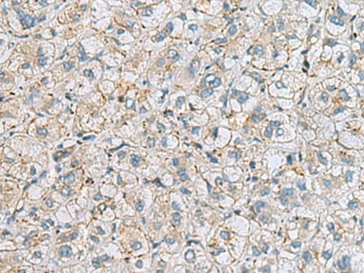 Immunohistochemistry of paraffin-embedded Human liver cancer tissue using MTHFD2 Polyclonal Antibody at dilution of 1:65(×200)