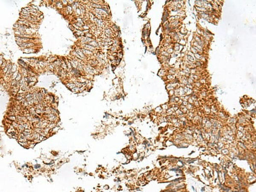 Immunohistochemistry of paraffin-embedded Human colorectal cancer tissue using GPR119 Polyclonal Antibody at dilution of 1:45(×200)