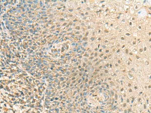 Immunohistochemistry of paraffin-embedded Human tonsil tissue using PPCDC Polyclonal Antibody at dilution of 1:55(×200)