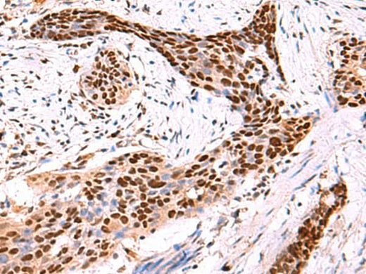Immunohistochemistry of paraffin-embedded Human esophagus cancer tissue using SOX2 Polyclonal Antibody at dilution of 1:50(×200)