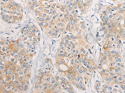 Immunohistochemistry of paraffin-embedded Human prost at e cancer tissue using CPD Polyclonal Antibody at dilution of 1:70(×200)
