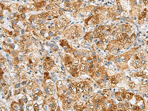 Immunohistochemistry of paraffin-embedded Human liver cancer tissue using NMU Polyclonal Antibody at dilution of 1:80(×200)