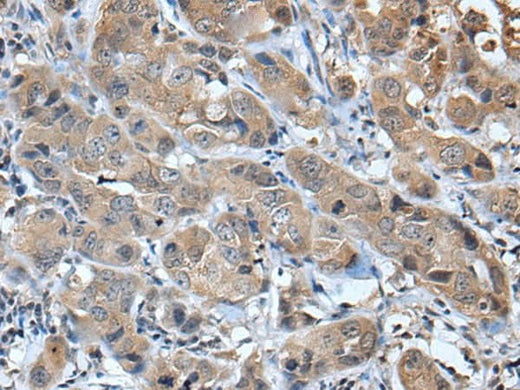 Immunohistochemistry of paraffin-embedded Human breast cancer tissue using CXCL5 Polyclonal Antibody at dilution of 1:45(×200)
