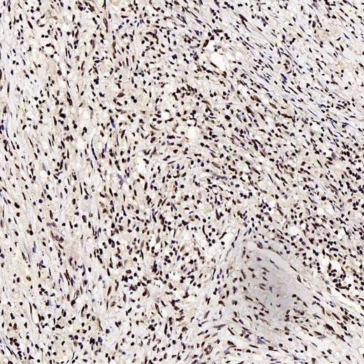 Immunohistochemistry analysis of paraffin-embedded human lung cancer using c-Fos Polyclonal Antibody at dilution of 1:200.