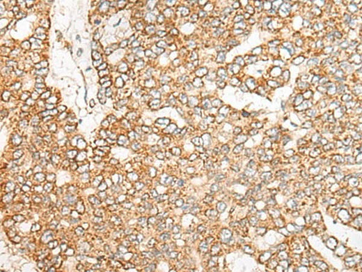 Immunohistochemistry of paraffin-embedded Human liver cancer tissue using NME4 Polyclonal Antibody at dilution of 1:45(×200)