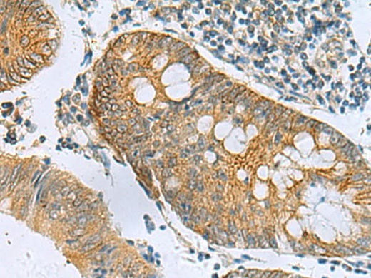 Immunohistochemistry of paraffin-embedded Human colorectal cancer tissue using GUCA1A Polyclonal Antibody at dilution of 1:105(×200)