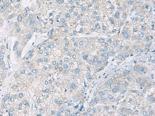Immunohistochemistry of paraffin-embedded Human liver cancer tissue using DACT3 Polyclonal Antibody at dilution of 1:55(×200)