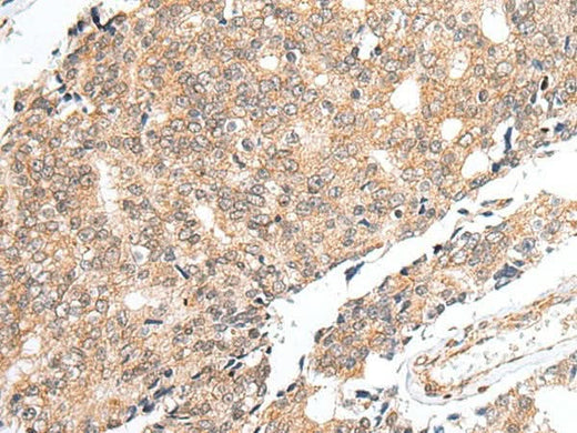 Immunohistochemistry of paraffin-embedded Human prost at e cancer tissue using PRELID1 Polyclonal Antibody at dilution of 1:40(×200)