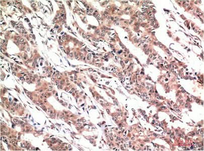 Immunohistochemistry of paraffin-embedded Human colon carcinoma tissue using Phospho-STAT3 (Tyr705) Monoclonal Antibody at dilution of 1:200.